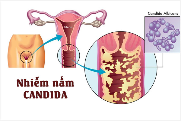 Cách điều trị nấm Candida vùng kín hiệu quả, an toàn