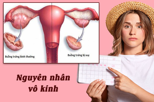 Nguyên nhân gây vô kinh và cách điều trị hiệu quả