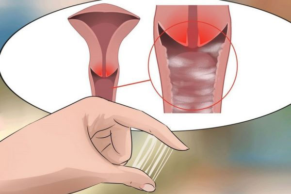 Nhiễm khuẩn nhiễm trùng âm đạo rất nhiều người bỏ qua triệu chứng