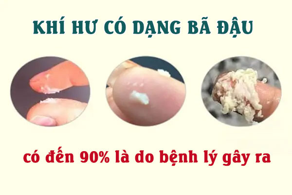 Ra dịch bã đậu ở vùng kín là dấu hiệu gì? Có nguy hiểm không?