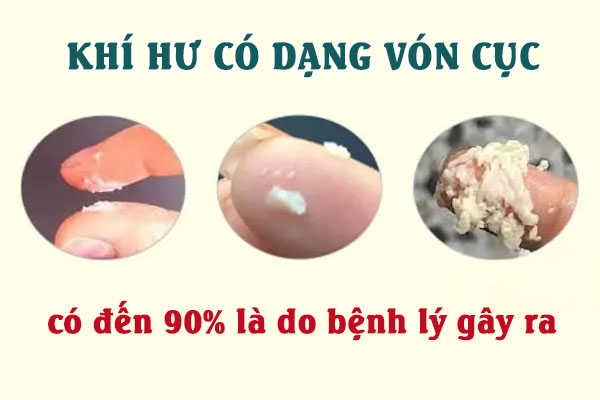 Vùng kín ra dịch vón cục là bị gì? Cách chữa hiệu quả?