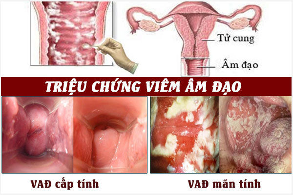 Viem-am-dao-cap-va-man-tinh
