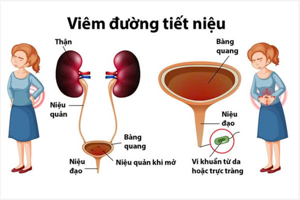Viem-duong-tiet-nieu-nu