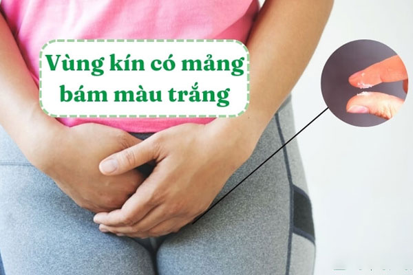 Vùng kín có mảng bám màu trắng phải làm sao?