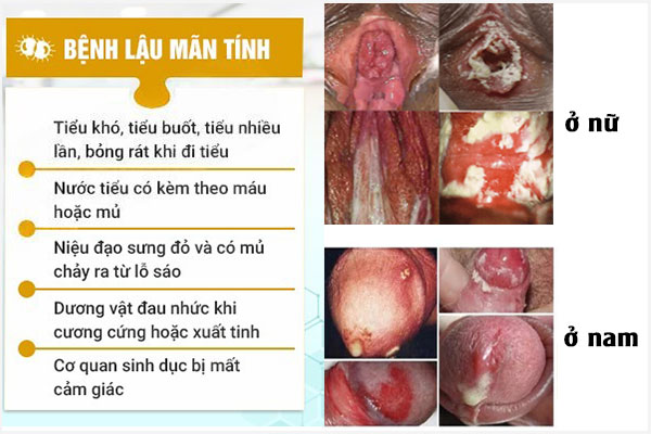 Benh-lau-man-tinh