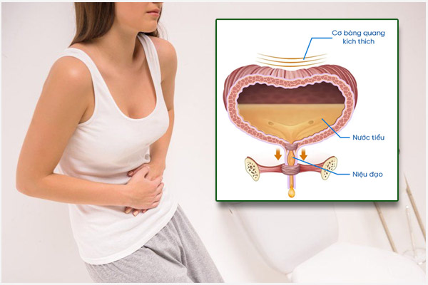Bị bí tiểu nữ: Nguyên nhân và Cách khắc phục hiệu quả