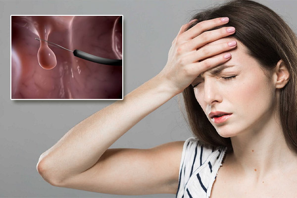 Cat-polyp-co-tu-cung-1