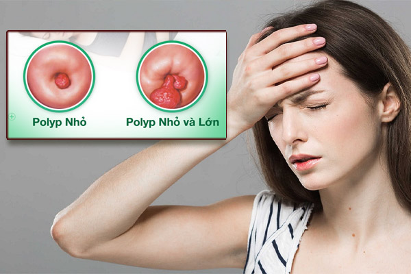 Cắt Polyp cổ tử cung có nguy hiểm không? Địa chỉ cắt polyp ở đâu an toàn và uy tín