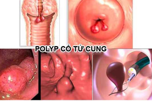 Cat-polyp-co-tu-cung