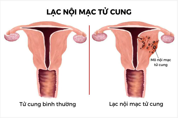 Lac-noi-mac-tu-cung-1