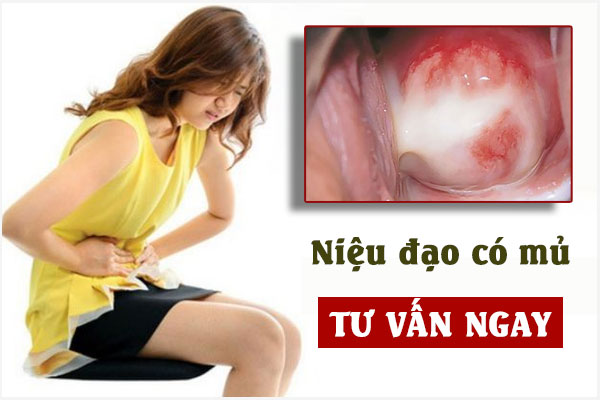 Niệu đạo chảy mủ là bị gì? Có nguy hiểm không?