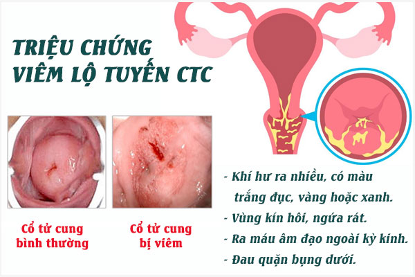 Viem-lo-tuyen-co-tu-cung-2
