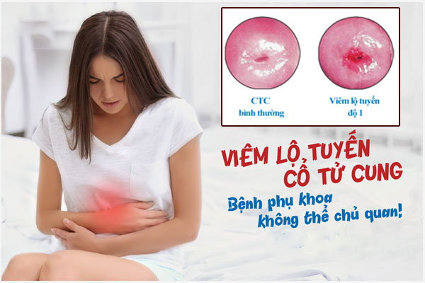Viem-lo-tuyen-co-tu-cung-cap-do-1