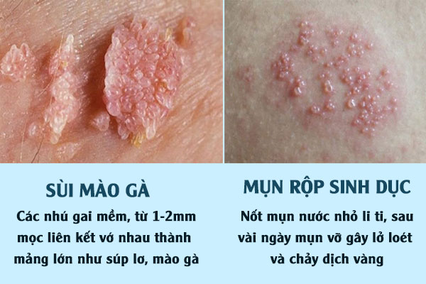 Sui-mao-ga-mun-rop-sinh-duc